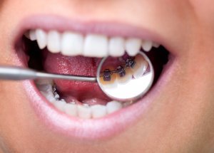 Photo of Brackets linguales: La ortodoncia perfecta si trabajas de cara al público