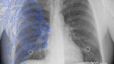 Photo of Detección de riesgo de cáncer de pulmón usando Inteligencia Artificial